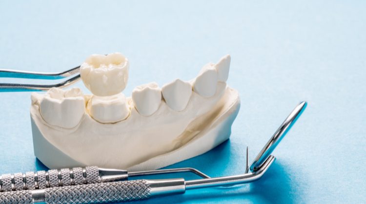 Dental crown model with tools at Dental Nation, Las Vegas, NV.