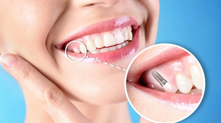 Close-up of a smiling woman with a dental implant illustration, highlighting tooth restoration by Dental Nation in Las Vegas, NV.