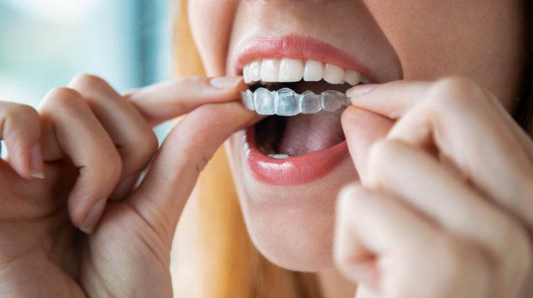 Woman inserting clear Invisalign aligners | Dental Nation, Las Vegas, NV