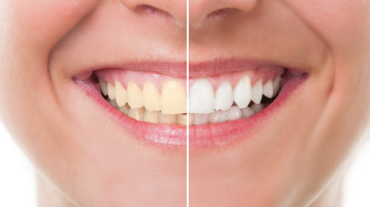Before and after comparison of a patient's smile showing the results of professional teeth whitening at Dental Nation in Las Vegas, NV — left side shows stained teeth, right side shows bright, white teeth.