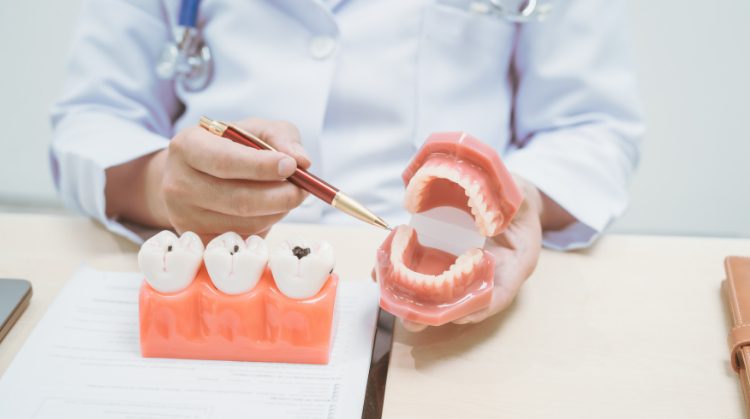 Dentist at Dental Nation in Las Vegas, NV explaining cavity prevention and treatment using tooth and jaw models.