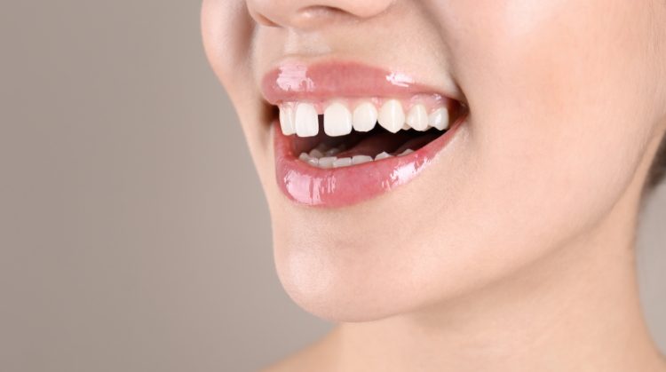 Close-up of a smiling woman showing gaps between her front teeth – Dental Nation, Las Vegas, NV
