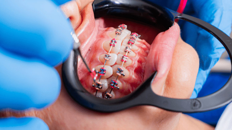 Close-up of dental braces being adjusted during treatment.
