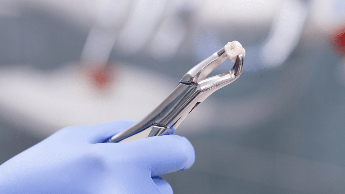 Gloved hand holding an extracted tooth with dental forceps.